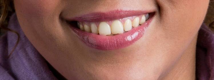 capture: Retouche des dents, image originale